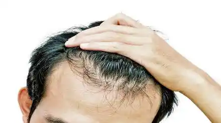 Homepage - Hair Loss Medications Review