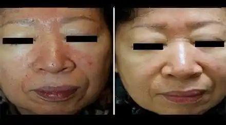 Homepage - Rosacea Disease Treatments Review